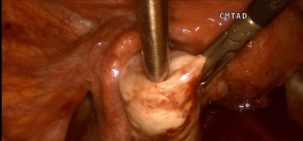 ЕНДОМЕТРІОЗ